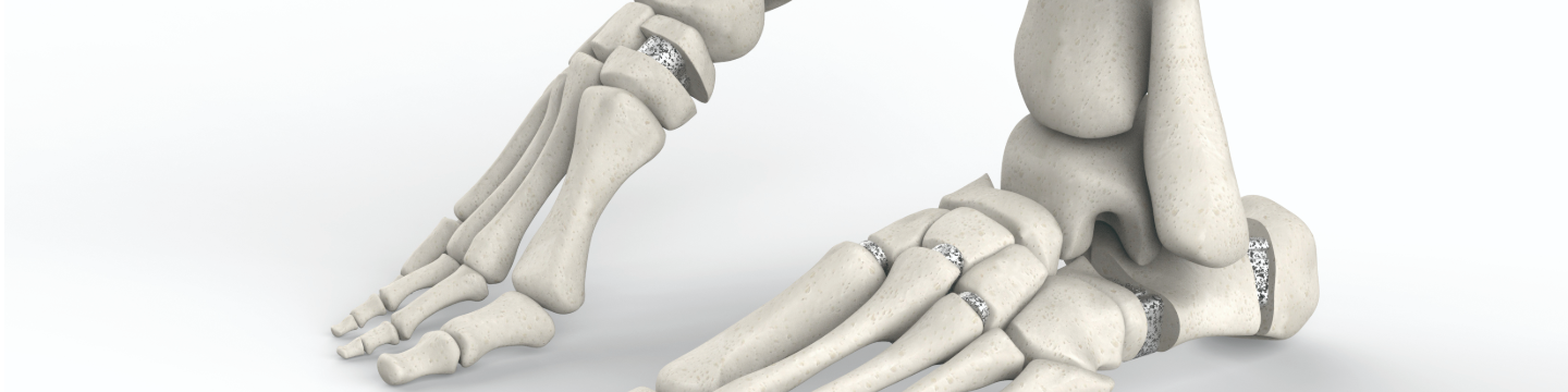 Ames Medical Prosthetic Solutions 170