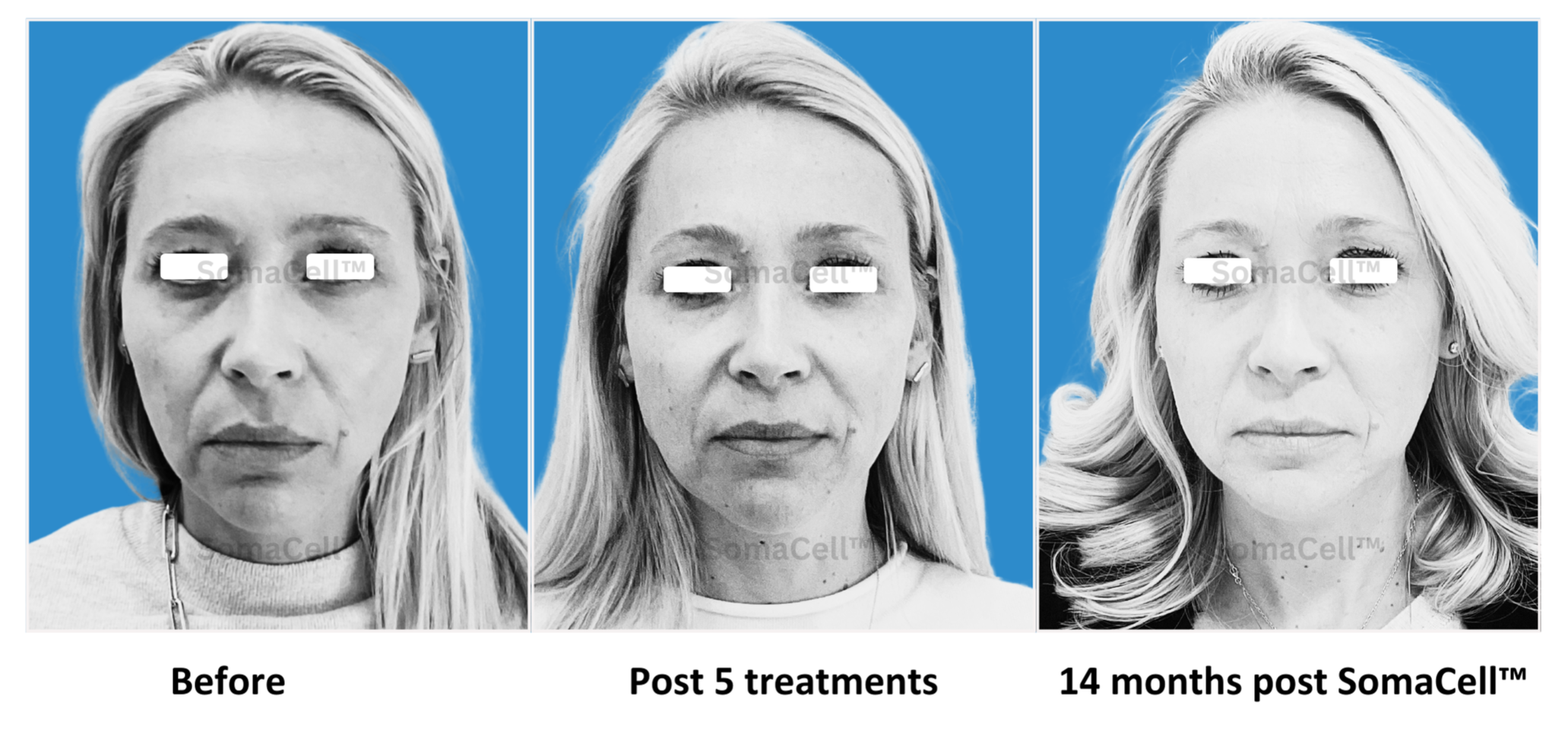 SomaCell™: The non-surgical alternative that actually works with surgery too 39