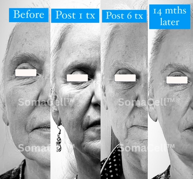 SomaCell™ The Meet show special 40