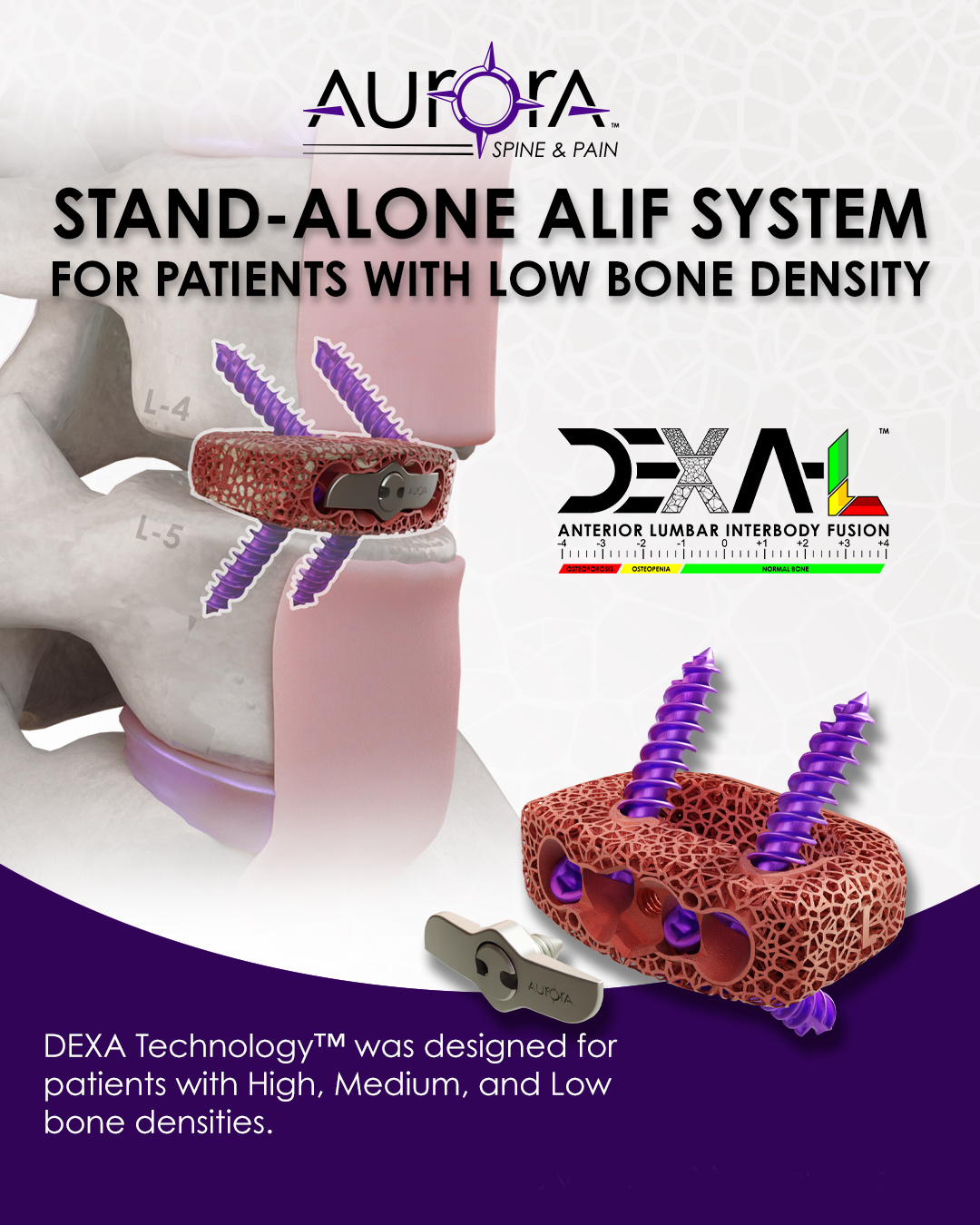 Aurora Spine Announces Launch of its DEXA-L™ Anterior Lumbar Interbody Fusion Device 158