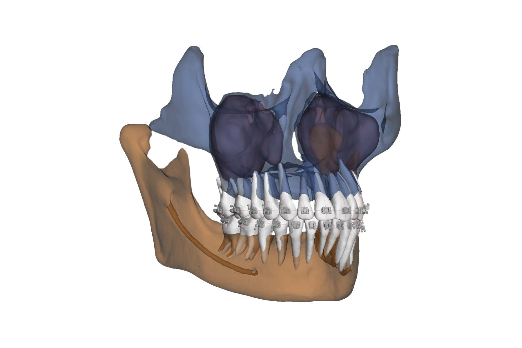 OrthoSelect announces Partnership with Relu to provide automated CBCT integration for DIBS AI software 247