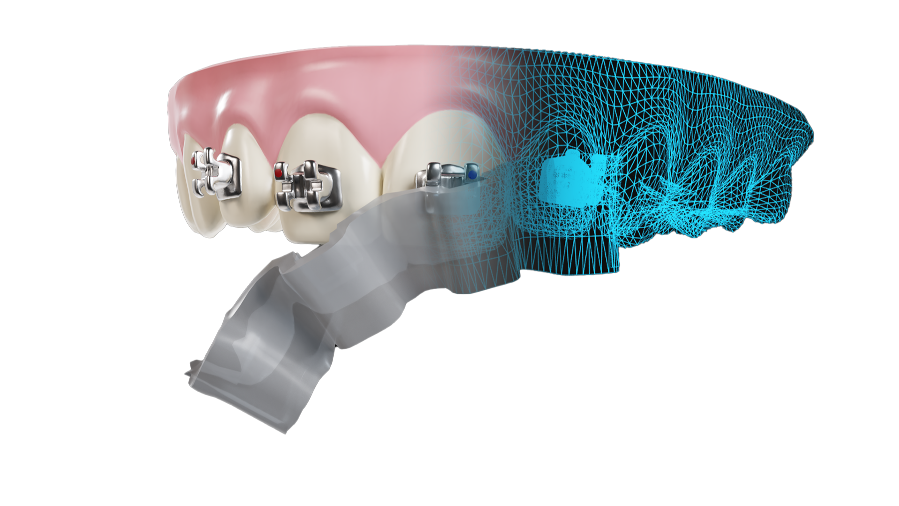 OrthoSelect announces the release of DIBS AI 8.0 263