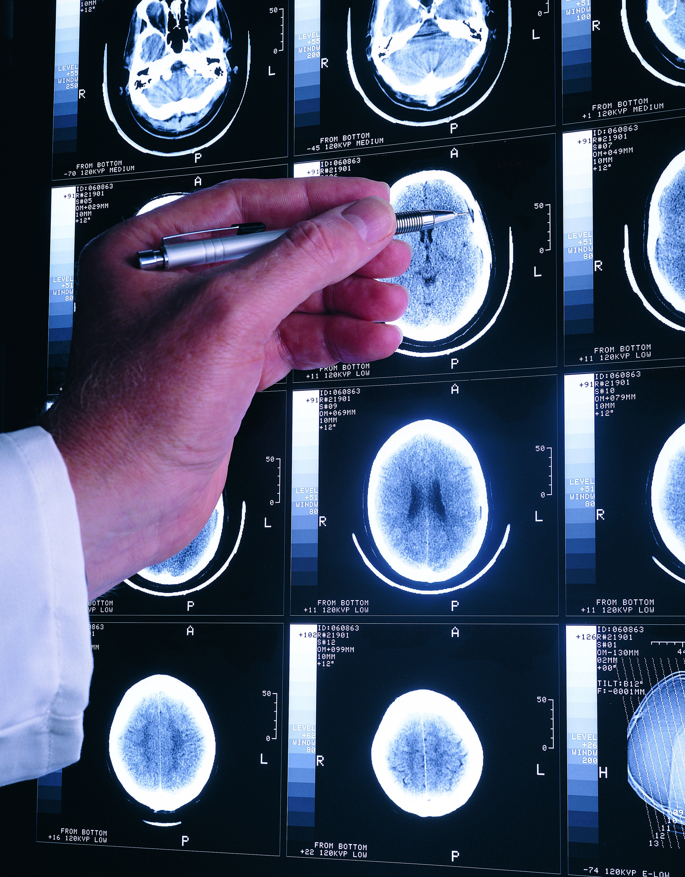 Neuroimaging PIA: Clinical Case Report 293