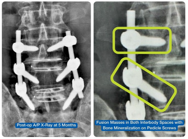 Nanovis Surpasses 500th Surgery Utilizing Nanotechnology Designated Screws 199