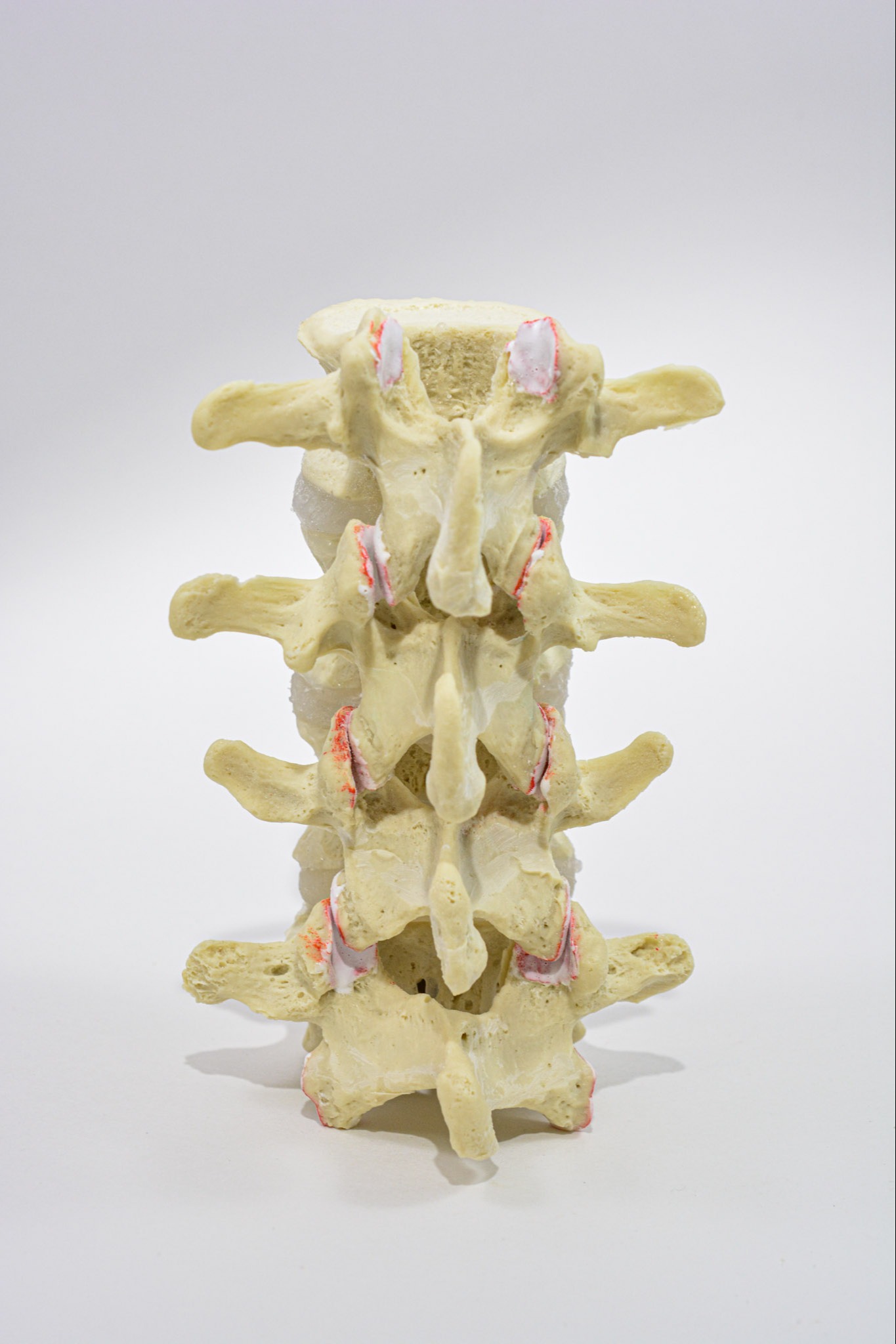 Instability Lumbar Model 19