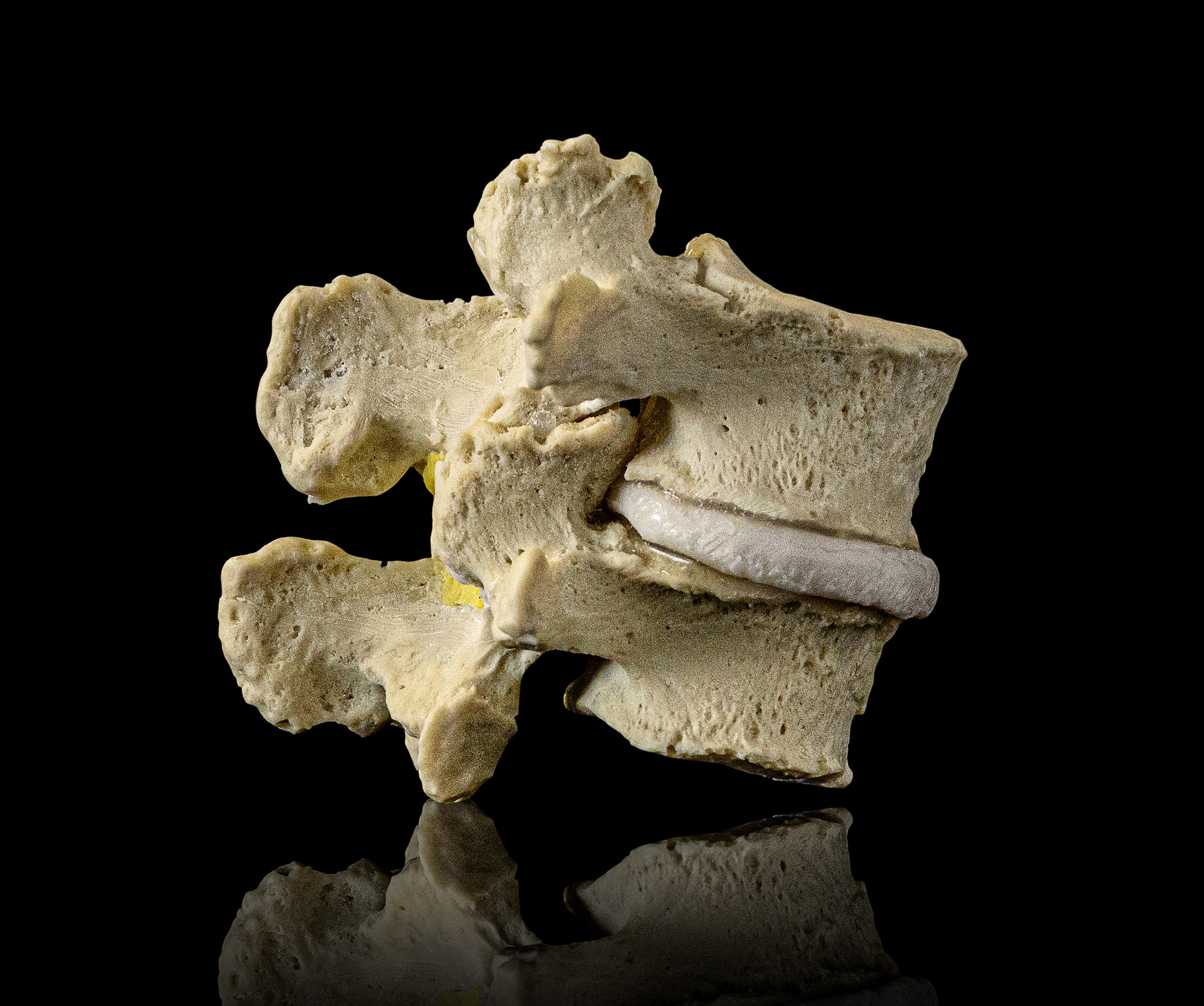 Lumbar Spinal Stenosis Dynamic Disc Model 20