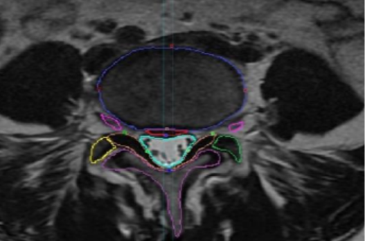 Automatic Segmentation of Lumbar Spine MRI Using Ensemble of 2D Algorithms 254