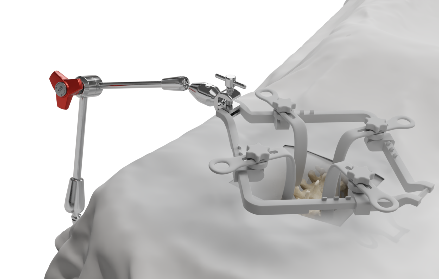 FISSO Articulated Arms for Spinal Surgery 74