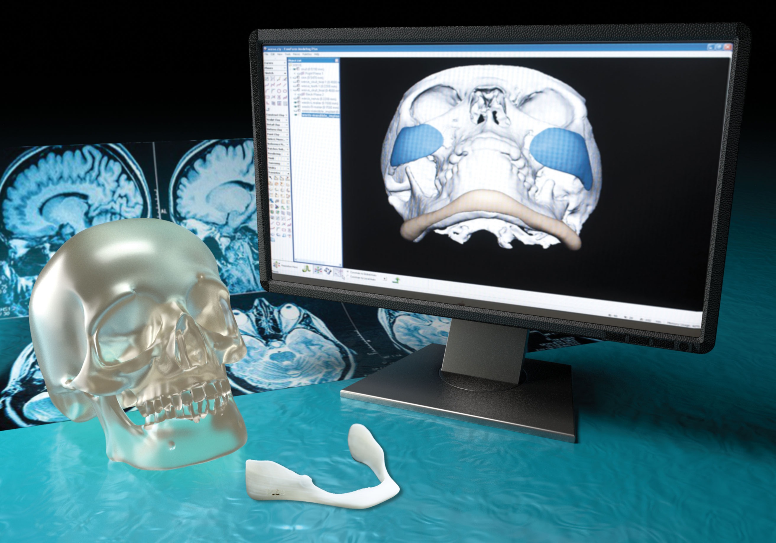 3D Accuscan Patient-Specific® Implants 109